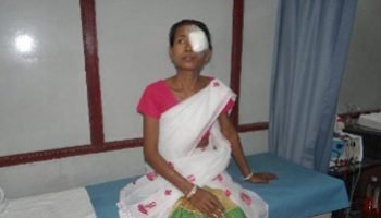 Eye Cataract_5 Eye Cataract_5